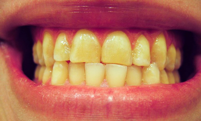 علت دندان قروچه شبانه